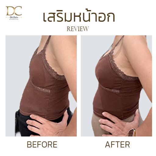รีวิวเสริมหน้าอก ซิลิโคน MOTIVA 375cc