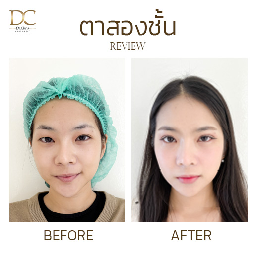 รีวิวทำตาสองชั้นแบบกรีดยาว กับจมูกแบบสโลปปลายพุ่ง