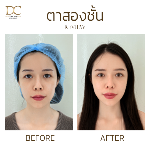 รีวิวทำตาสองชั้น ครั้งแรกในชีวิตบอกหมดไม่มีกัก