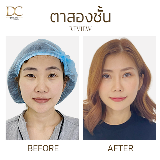 รีวิวทำตาสองชั้นเพิ่มความปัง! Before After
