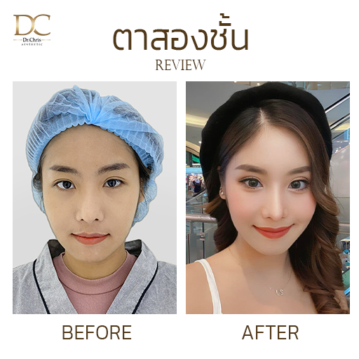 แชร์ประสบการณ์ แก้กล้ามเนื้อตาอ่อนแรง เปิดหัวตา ตาสวยมีเสน่ห์ Before After
