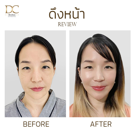รีวิวดึงหน้า 2 ส่วน โดยคุณหมอป่าน เชียงใหม่
