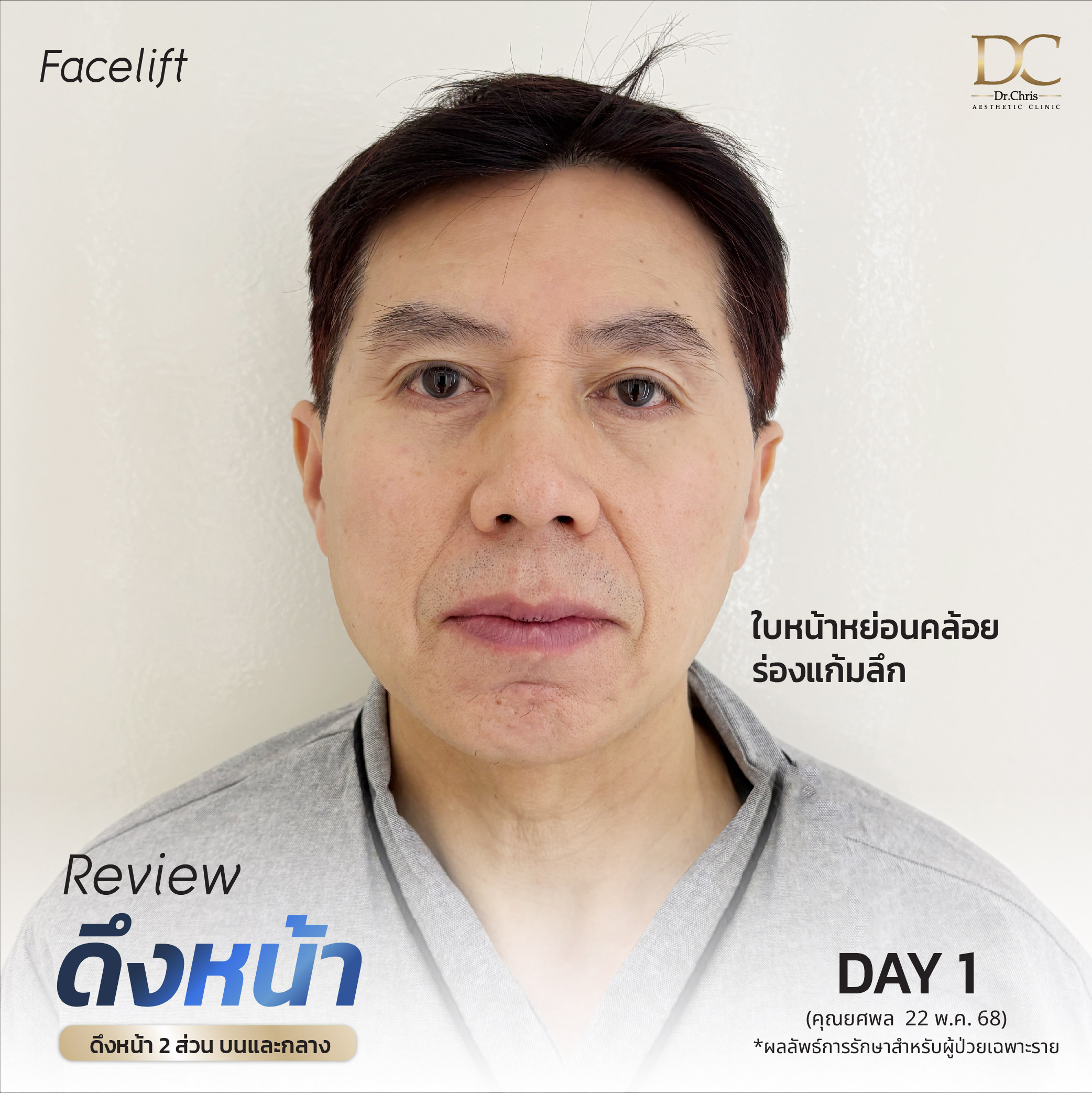 รีวิวดึงหน้า 2 ส่วน บนและกลาง โดยคุณหมอป่าน เชียงใหม่