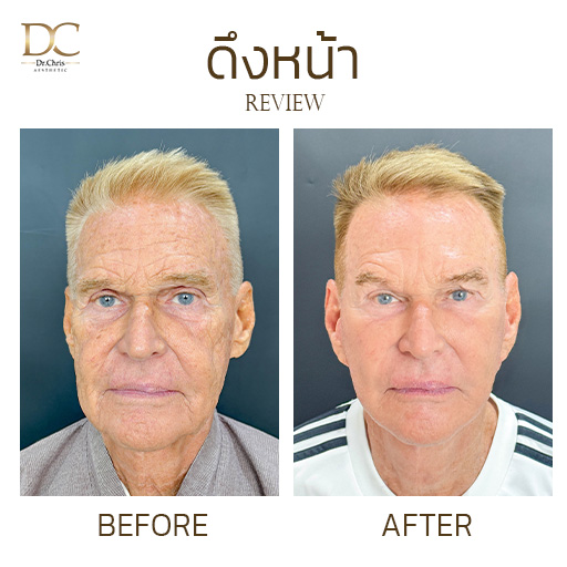 รีวิวดึงหน้า 3 ส่วน ผลลัพธ์ 1 วัน Before After