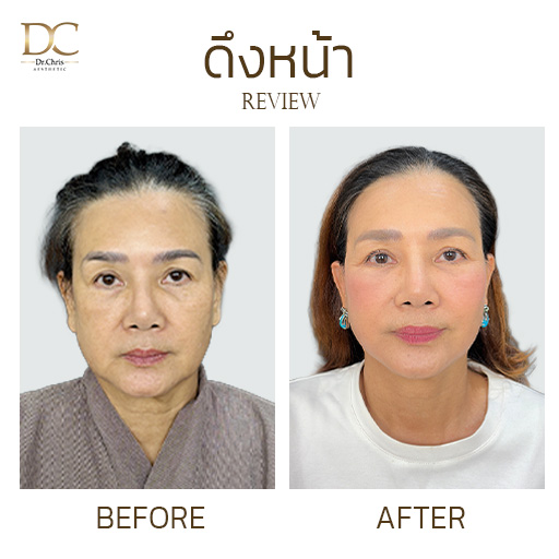 รีวิวดึงหน้าครั้งแรก แก้ปัญหาหน้าหย่อนคล้อย Before After