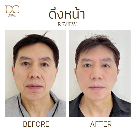 รีวิวดึงหน้า ผลลัพธ์ 1 เดือน | FACE-LIFT Before After
