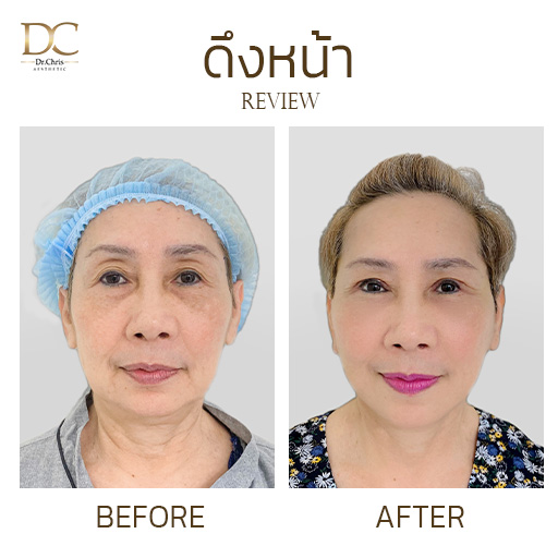 รีวิวดึงหน้า ผลลัพธ์ 14 วัน by คุณหมอป่านเชียงใหม่ Before After
