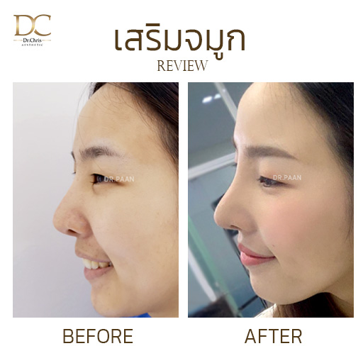 รีวิวแก้จมูกแบบเปิด (Open Rhinoplasty) — K.กรณ์นภัส Before After