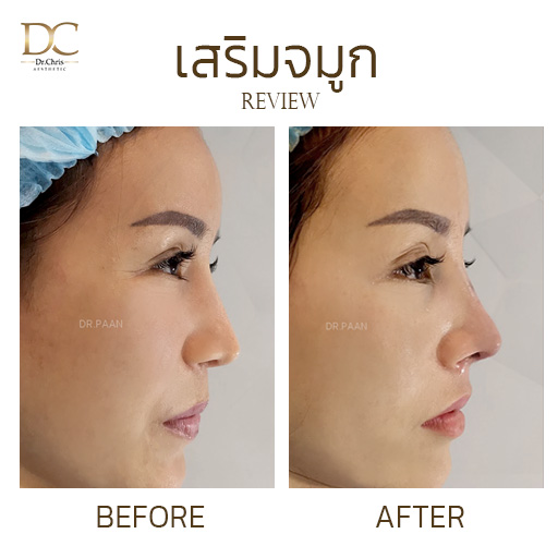 รีวิวแก้จมูกแบบเปิด (Open Rhinoplasty) — K.ธัญญาภรณ์ Before After