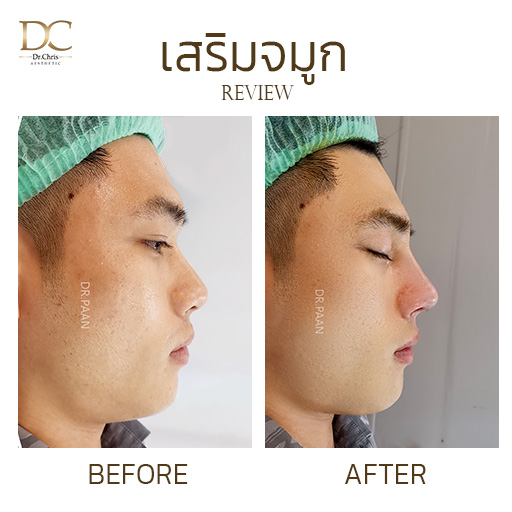 รีวิวเสริมจมูกด้วยกระดูกหลังหู (Ear Cartilage Rhinoplasty) Before After