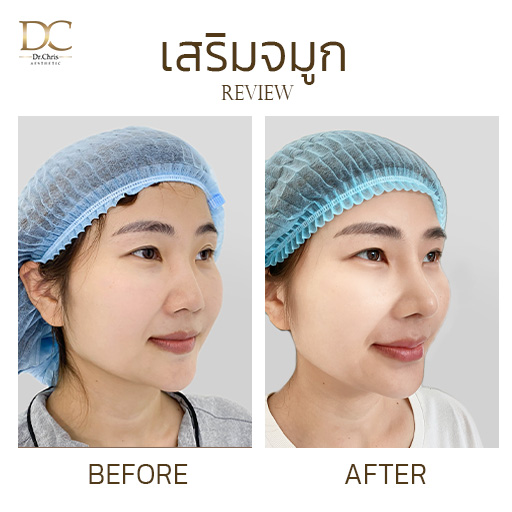 รีวิวเสริมจมูกเทคนิค OPEN (Open Rhinoplasty)