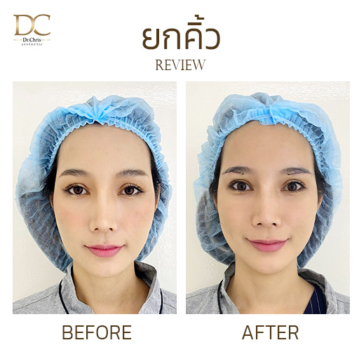 รีวิวยกคิ้ว ยกหางตาซ่อนแผลใต้คิ้ว แก้ปัญหาหางตาตก ให้ตาดูสดใสขึ้น Before After