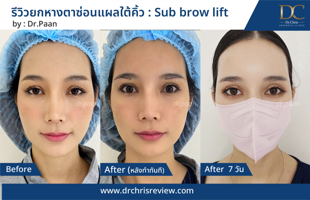 Before/After